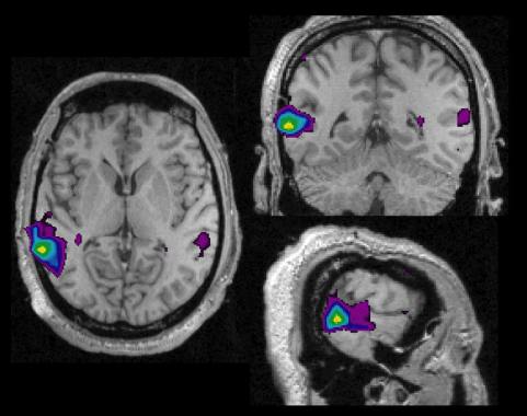 FMRI